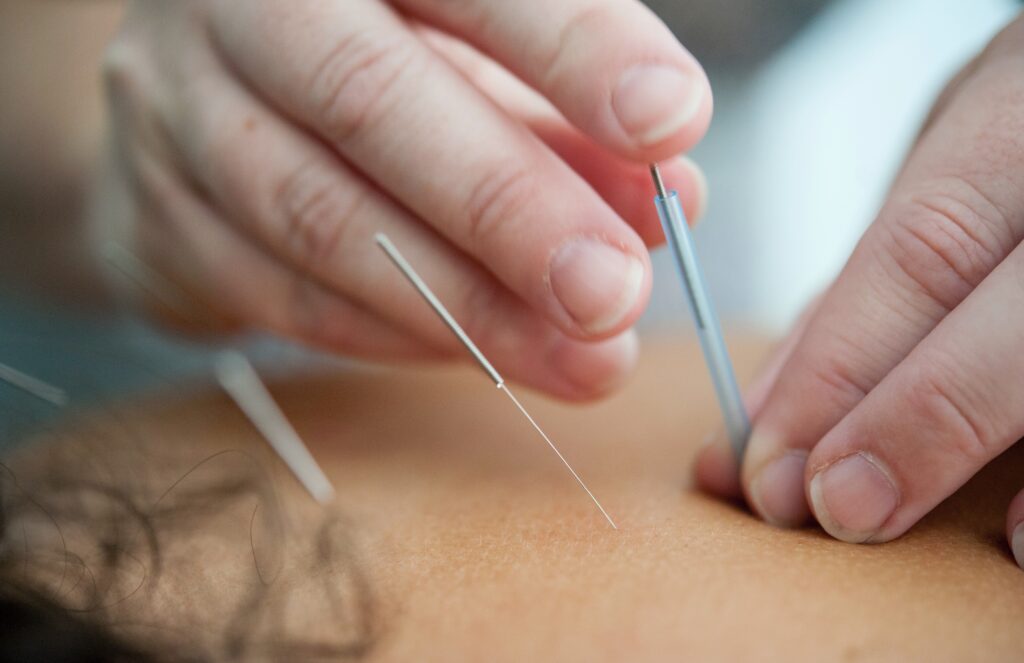 acupuncture fertility treatment
